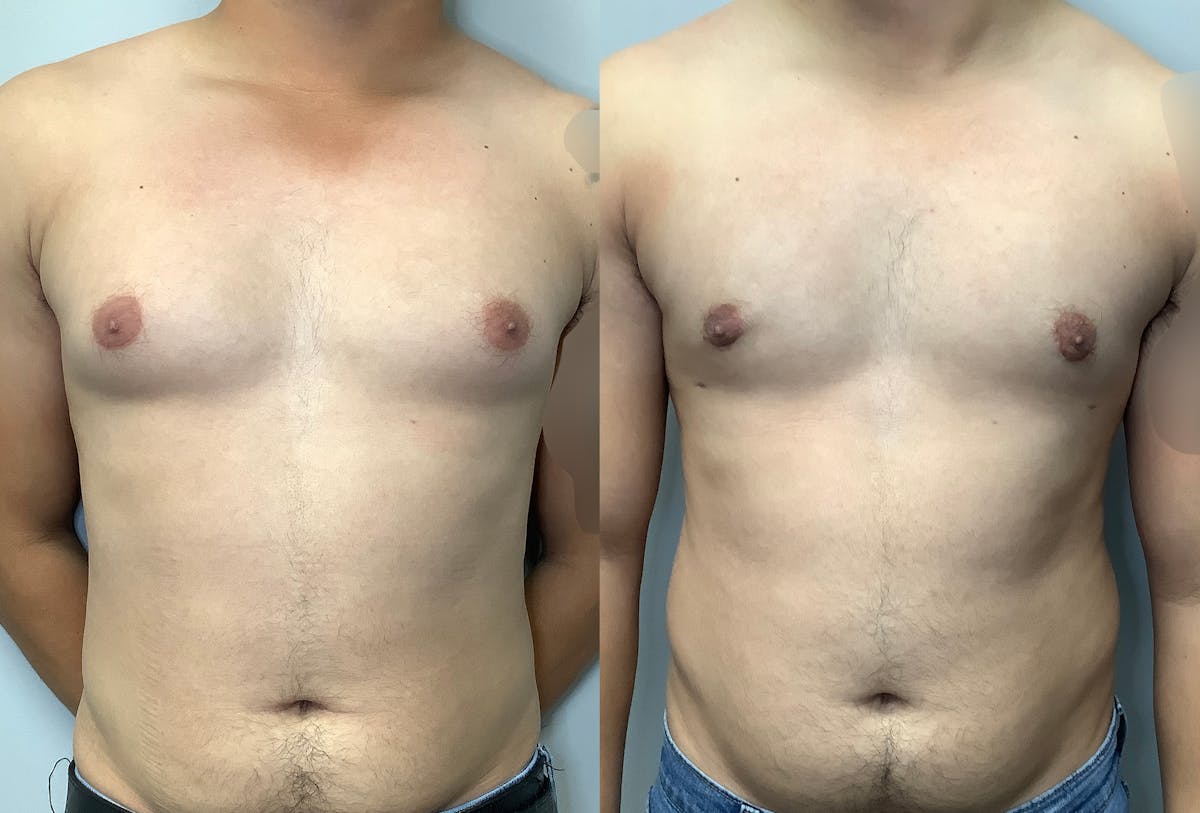 Gynecomastia Before & After Gallery - Patient 147667763 - Image 1