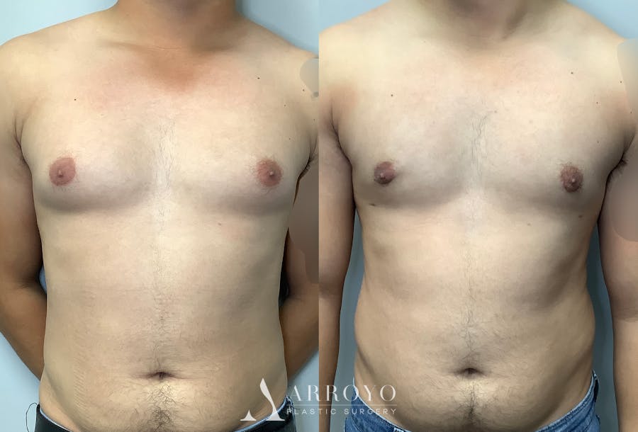 Gynecomastia Before & After Gallery - Patient 147667763 - Image 1