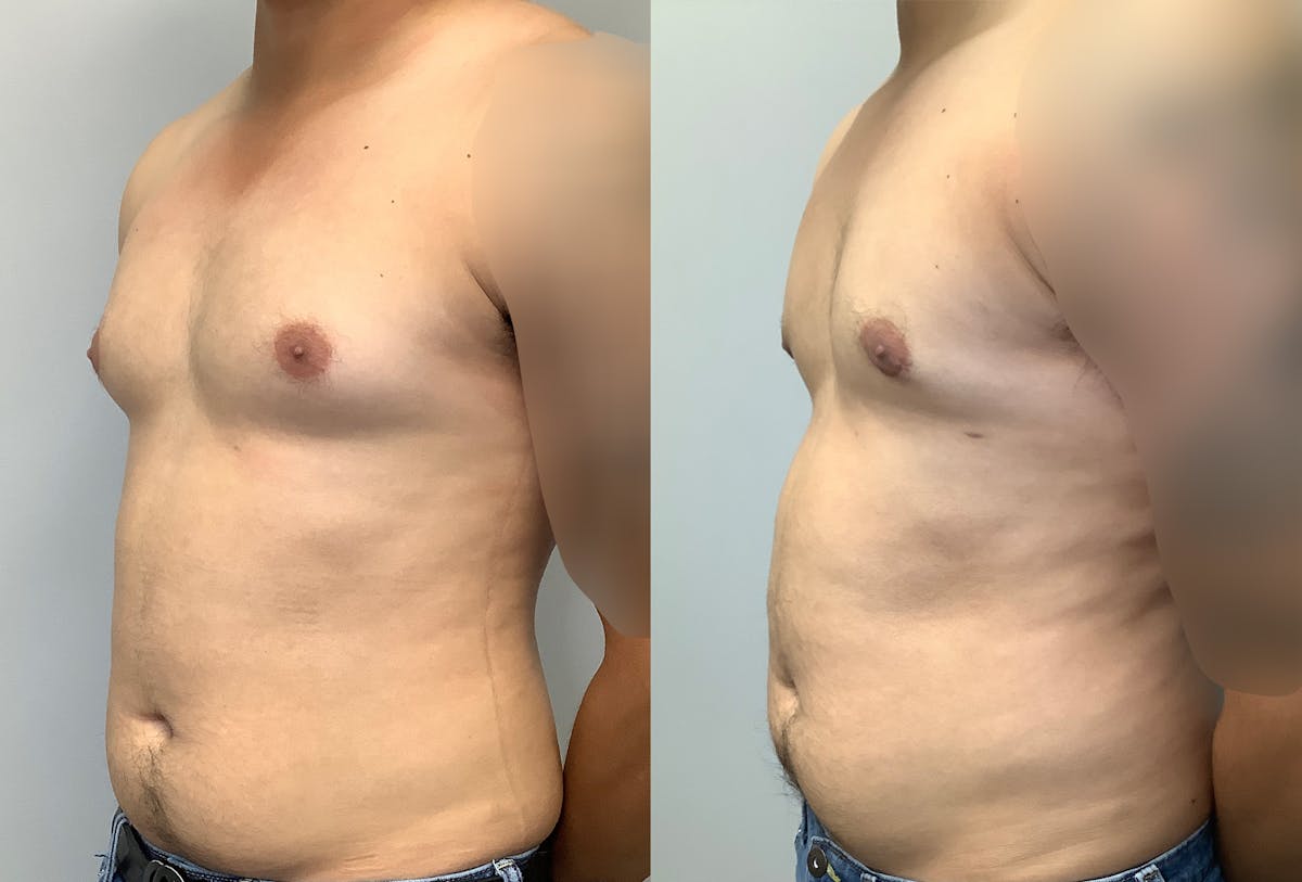 Gynecomastia Before & After Gallery - Patient 147667763 - Image 3