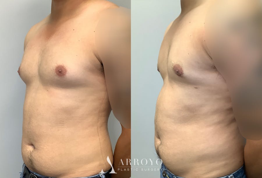 Gynecomastia Before & After Gallery - Patient 147667763 - Image 3