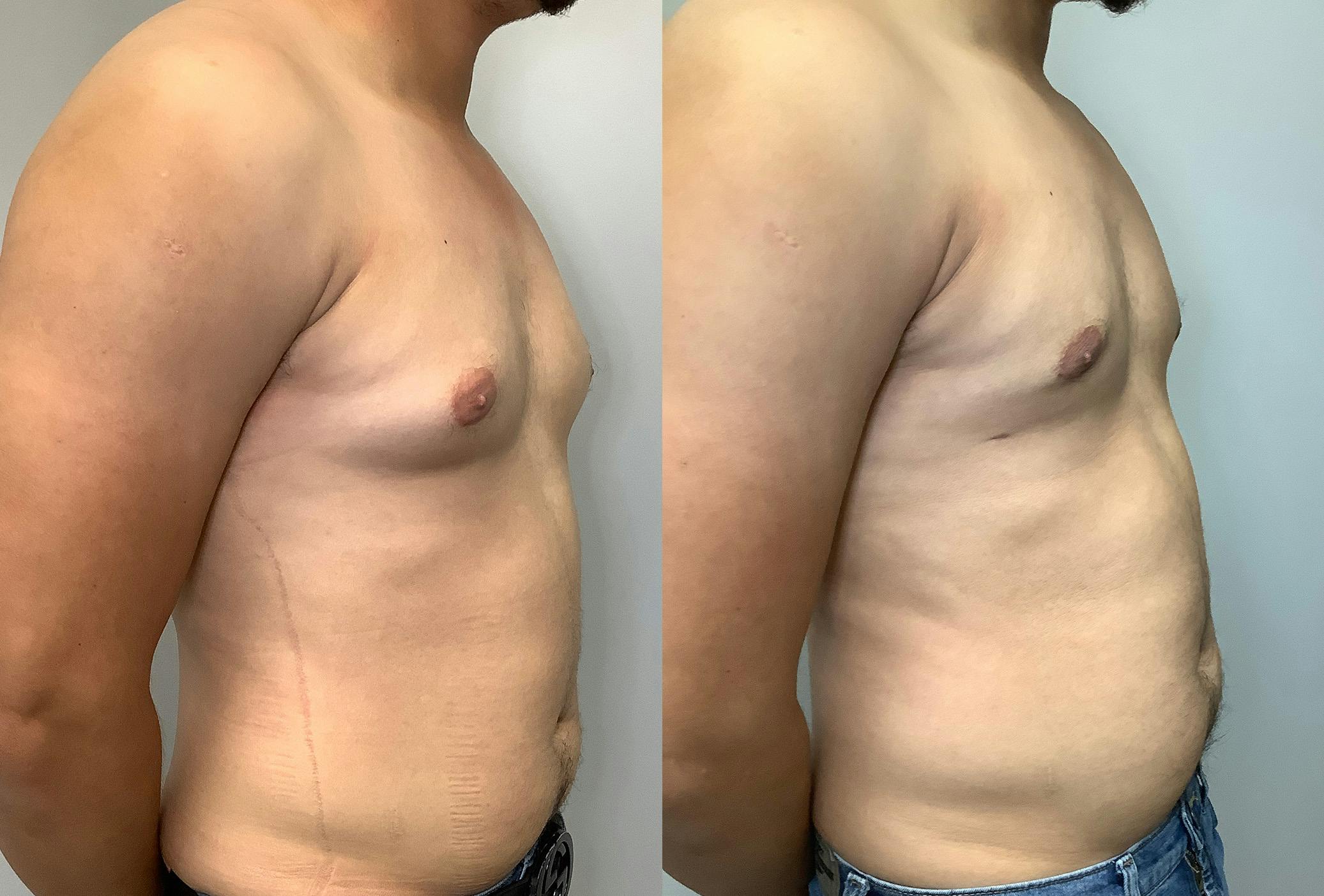 Gynecomastia Before & After Gallery - Patient 147667763 - Image 2