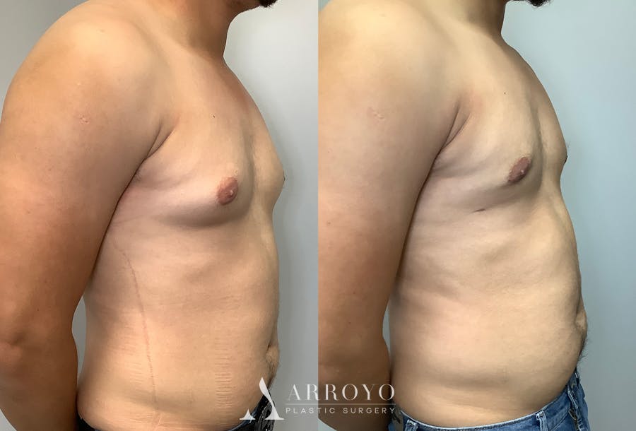 Gynecomastia Before & After Gallery - Patient 147667763 - Image 2