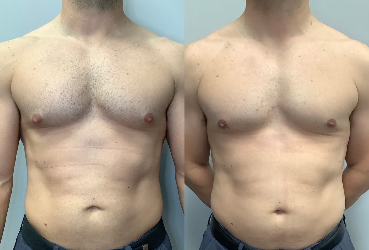 Gynecomastia Before & After Gallery - Patient 147667764 - Image 1