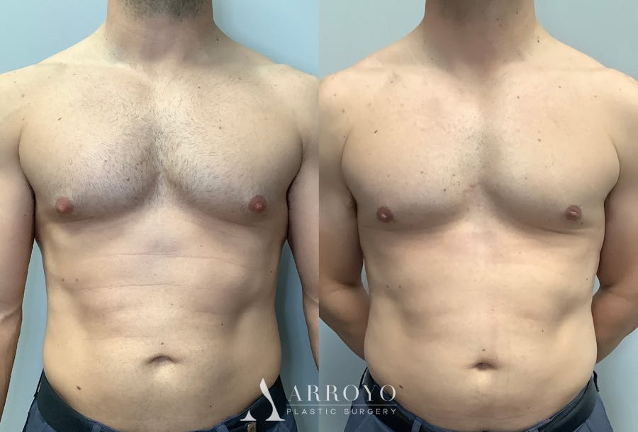Gynecomastia Before & After Gallery - Patient 147667764 - Image 1