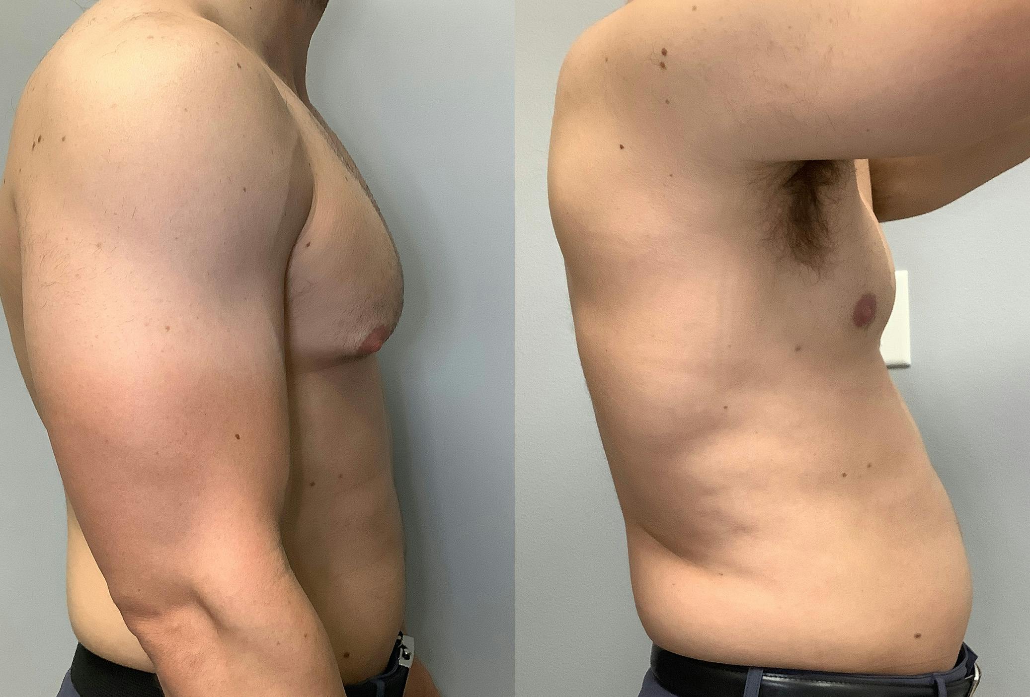 Gynecomastia Before & After Gallery - Patient 147667764 - Image 3
