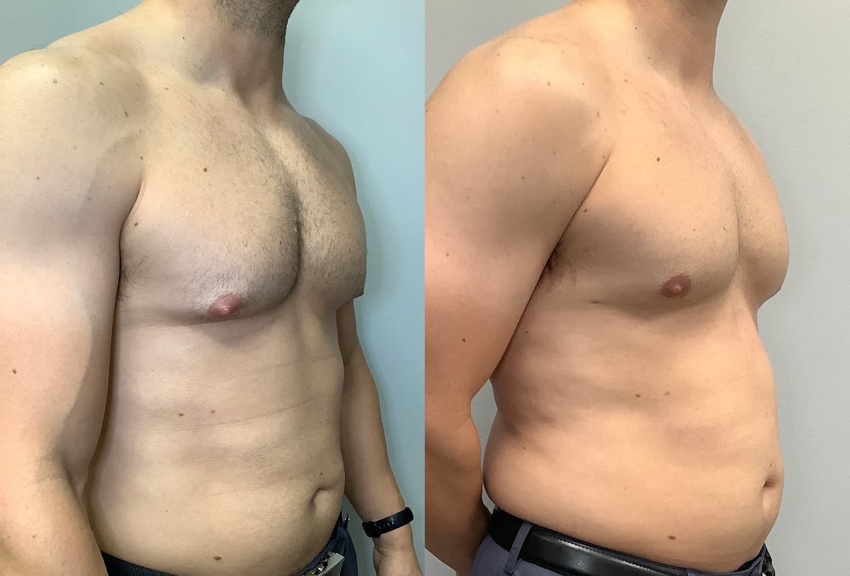 Gynecomastia Before & After Gallery - Patient 147667764 - Image 2