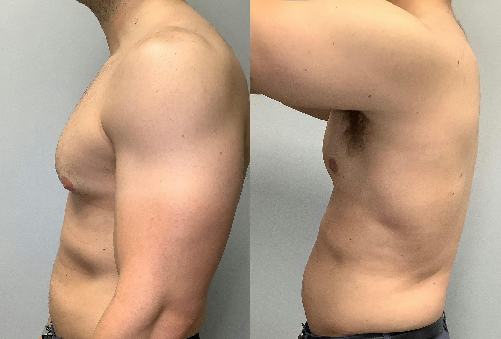 Gynecomastia Before & After Gallery - Patient 147667764 - Image 4