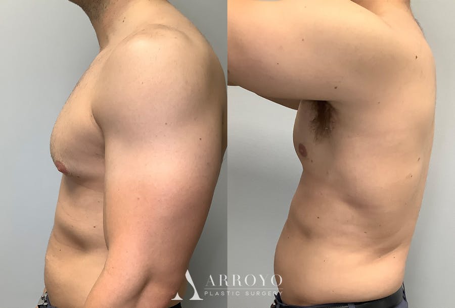 Gynecomastia Before & After Gallery - Patient 147667764 - Image 4