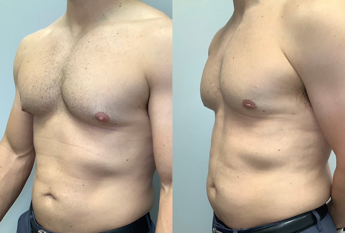Gynecomastia Before & After Gallery - Patient 147667764 - Image 5