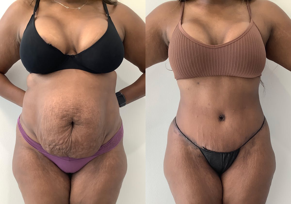 Liposuction Before & After Gallery - Patient 152125163 - Image 1