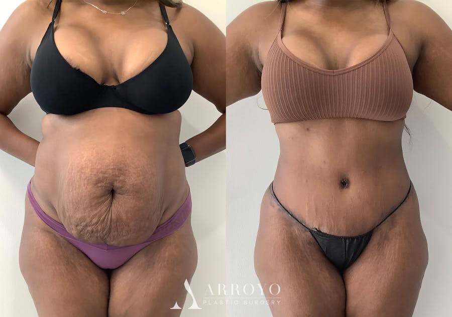 Tummy Tuck Before & After Gallery - Patient 152125191 - Image 1
