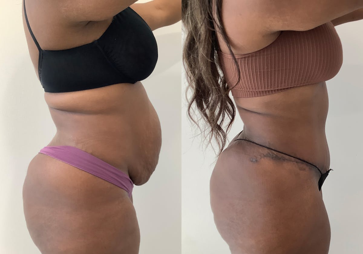 Liposuction Before & After Gallery - Patient 152125163 - Image 3