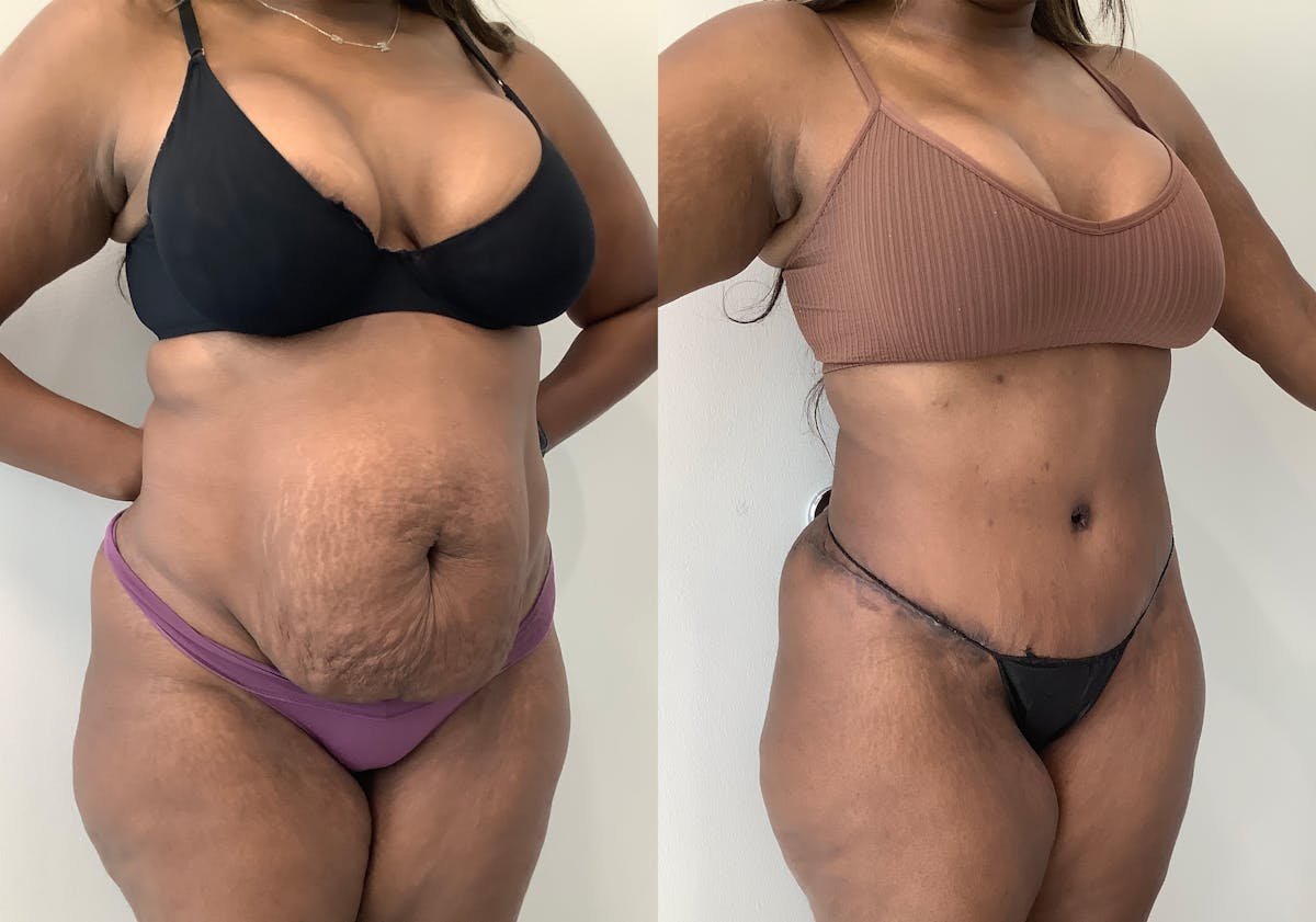 Tummy Tuck Before & After Gallery - Patient 152125191 - Image 2