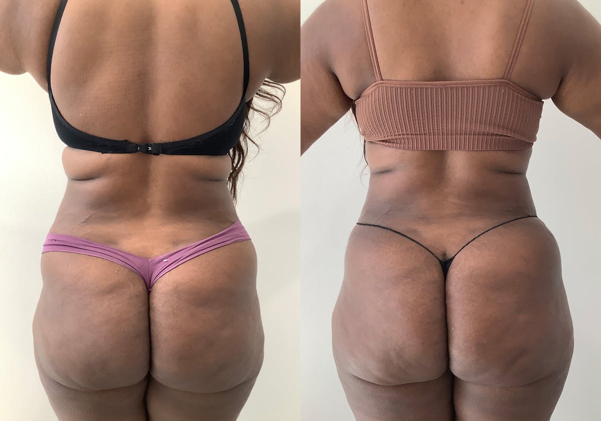 Liposuction Before & After Gallery - Patient 152125163 - Image 6