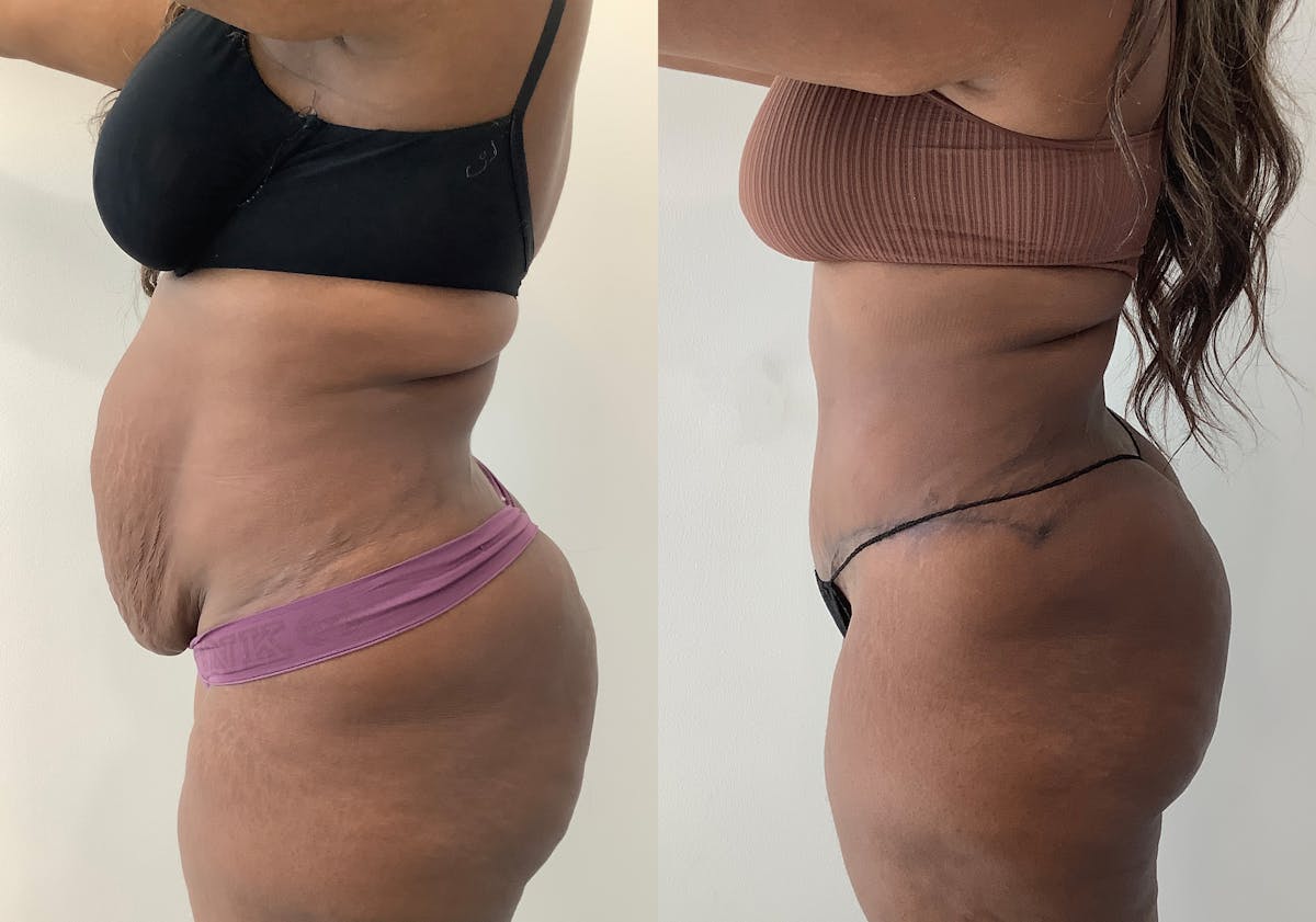 Tummy Tuck Before & After Gallery - Patient 152125191 - Image 5