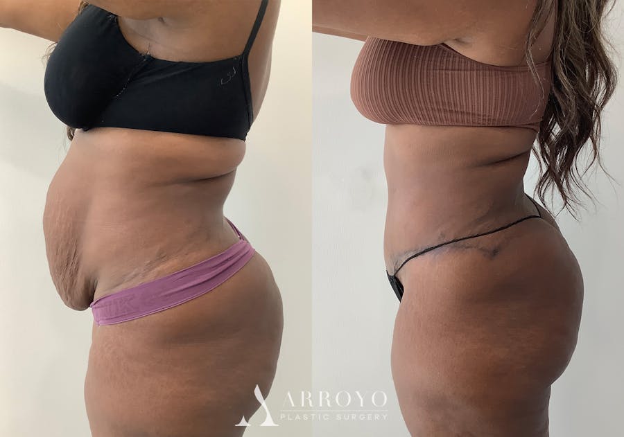 Tummy Tuck Before & After Gallery - Patient 152125191 - Image 5