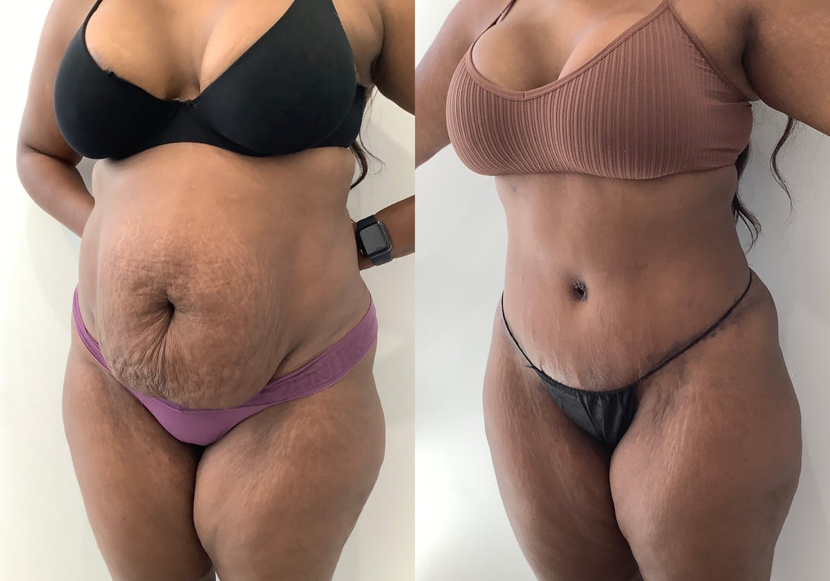Tummy Tuck Before & After Gallery - Patient 152125191 - Image 4