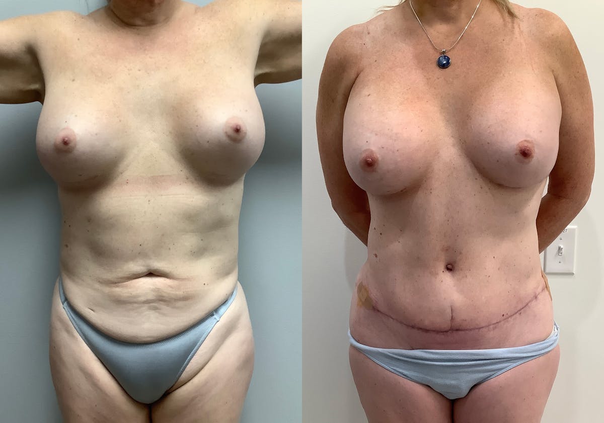 Liposuction Before & After Gallery - Patient 152125190 - Image 1