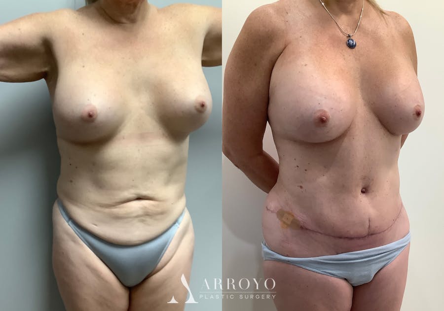 Liposuction Before & After Gallery - Patient 152125190 - Image 2