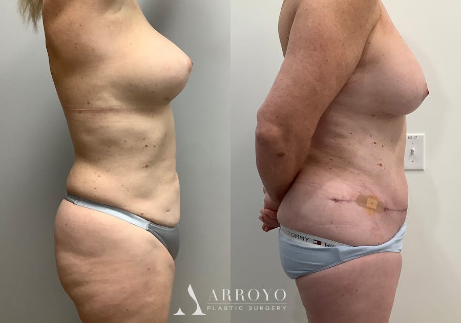 Liposuction Before & After Gallery - Patient 152125190 - Image 3