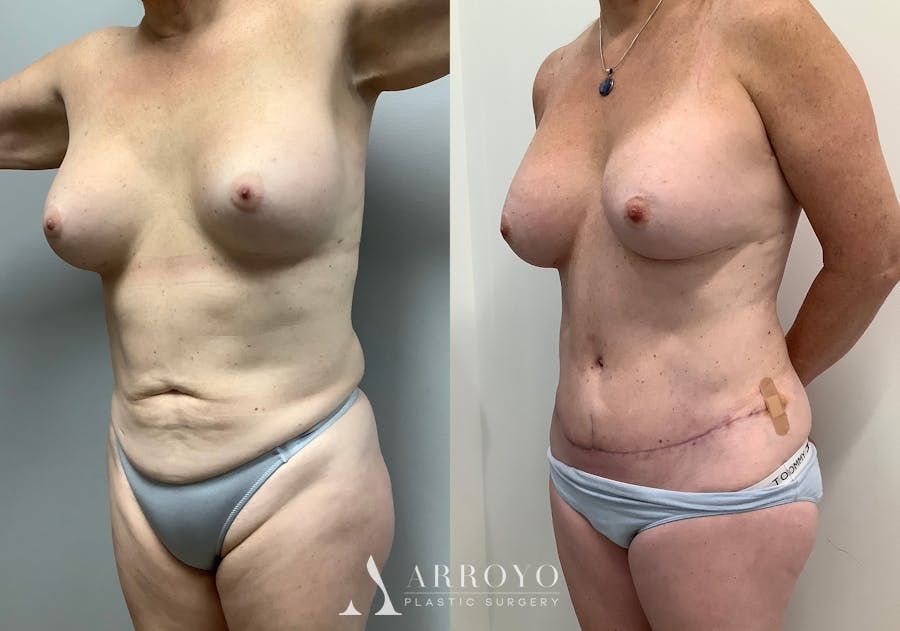 Liposuction Before & After Gallery - Patient 152125190 - Image 4