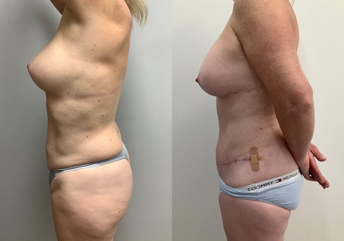 Liposuction Before & After Gallery - Patient 152125190 - Image 5
