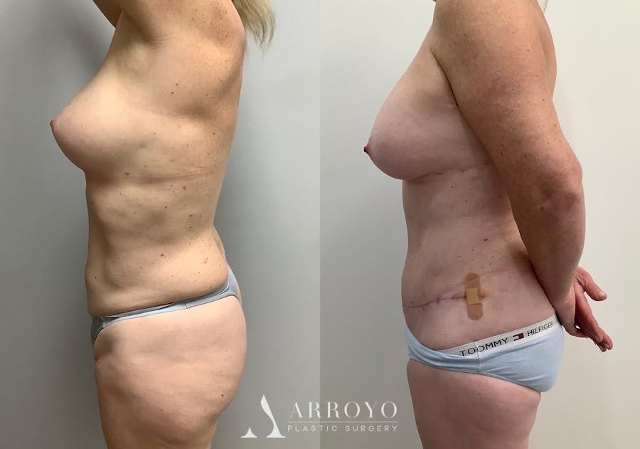 Liposuction Before & After Gallery - Patient 152125190 - Image 5