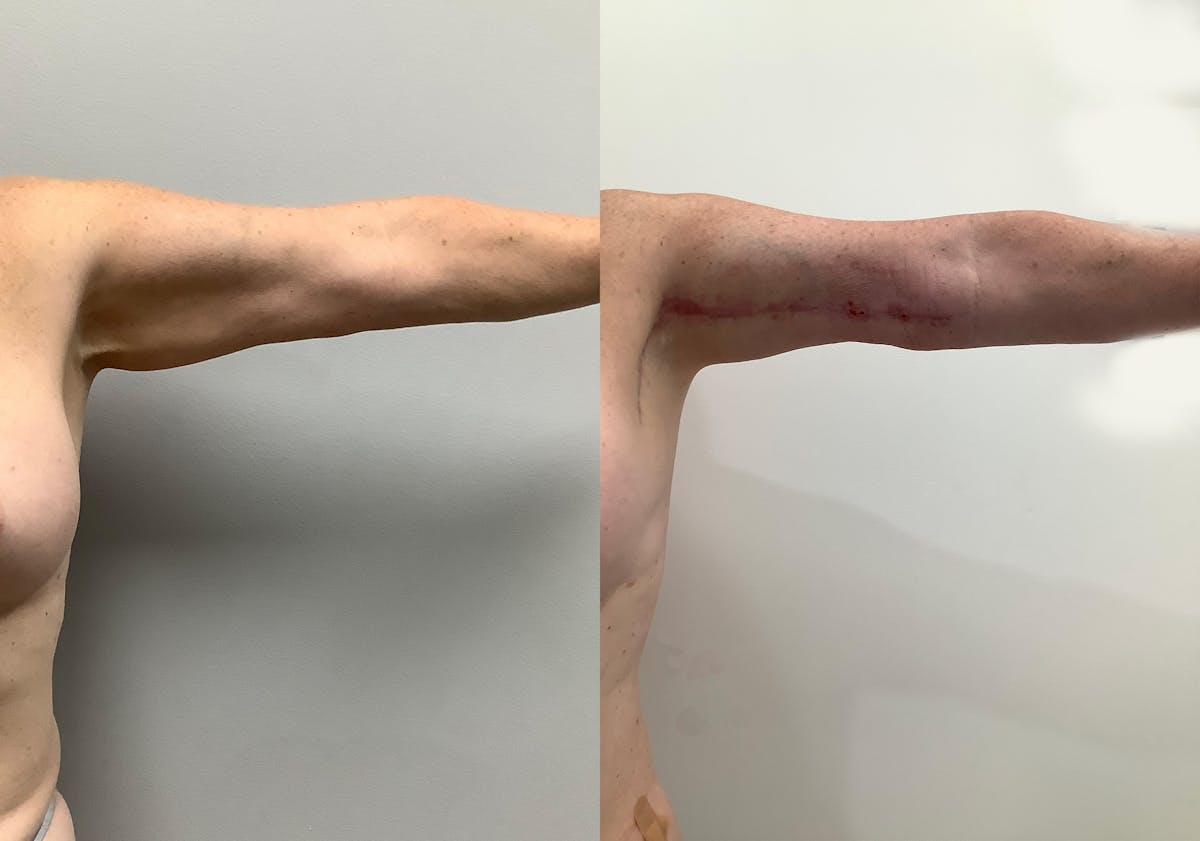 Brachioplasty (Arm Lift)  Before & After Gallery - Patient 152125192 - Image 1