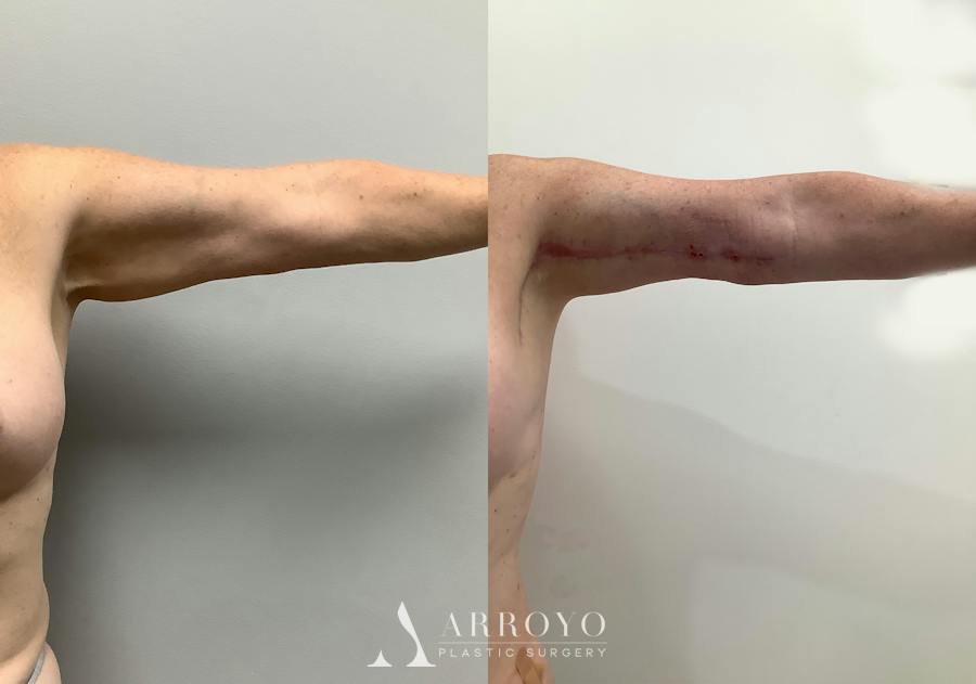 Brachioplasty (Arm Lift) Before & After Gallery - Patient 152125192 - Image 1