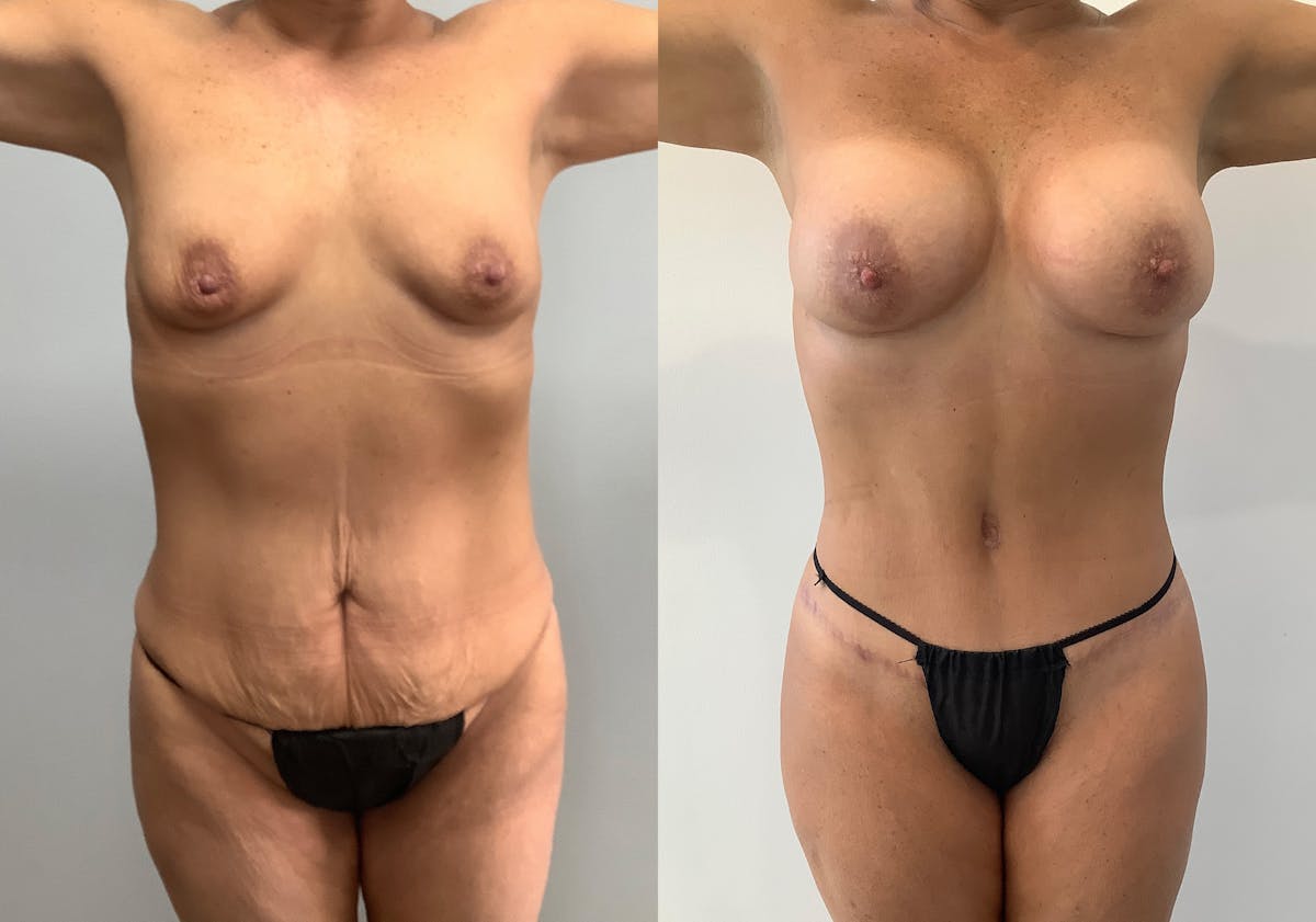 Body Lift Before & After Gallery - Patient 125050 - Image 1
