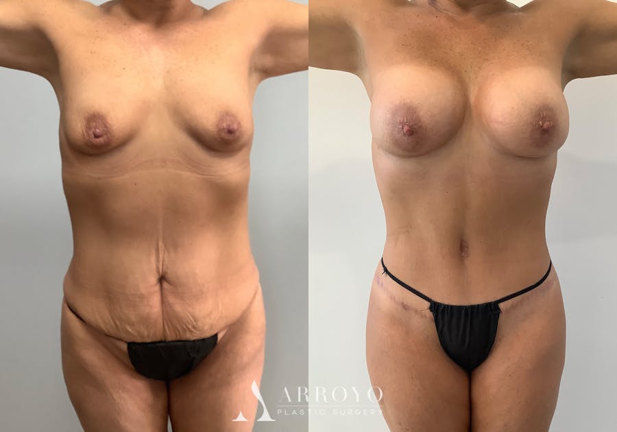 Body Lift Before & After Gallery - Patient 125050 - Image 1
