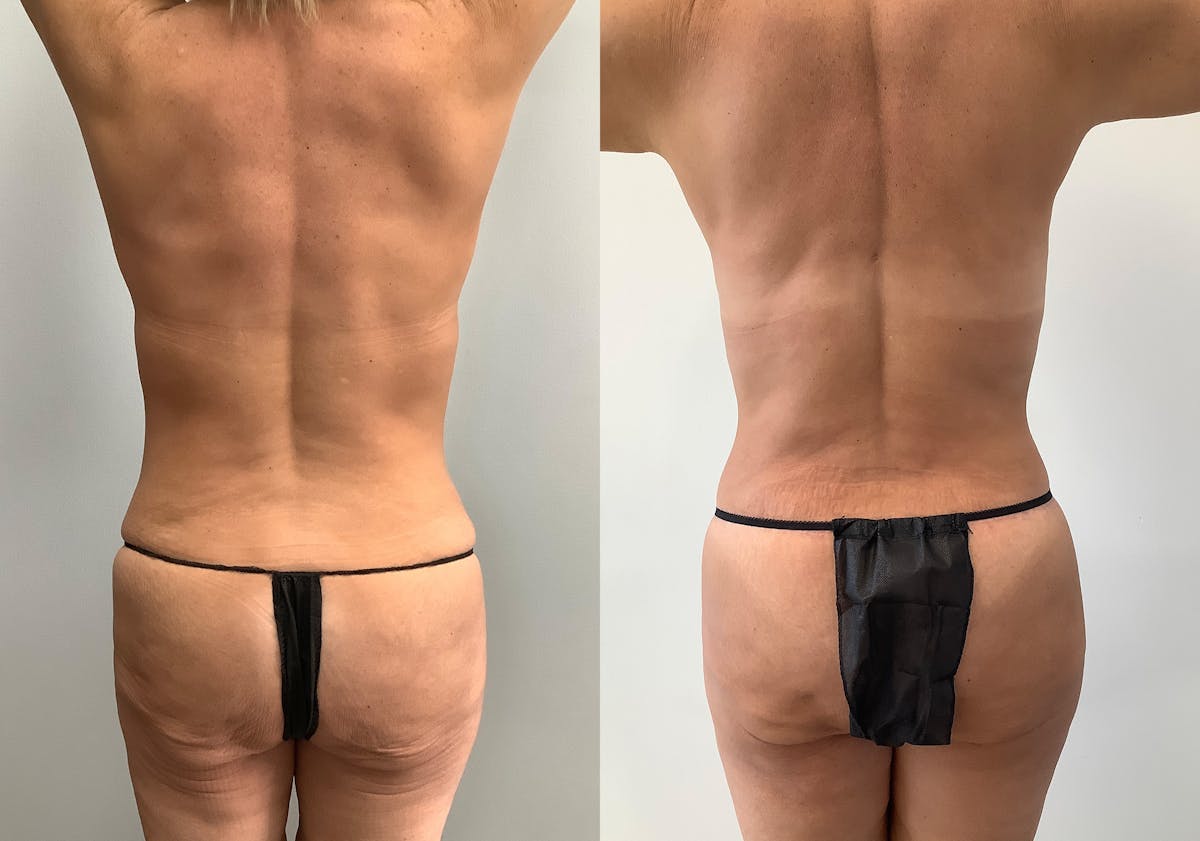 Body Lift Before & After Gallery - Patient 125050 - Image 2