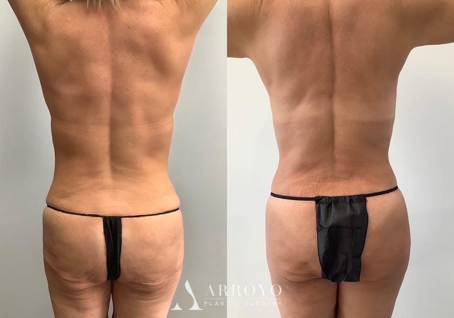 Body Lift Before & After Gallery - Patient 125050 - Image 2
