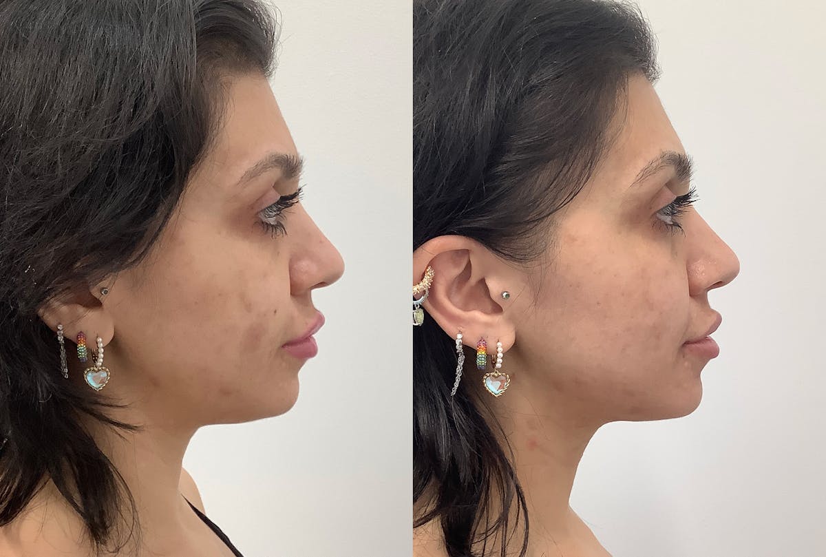Neck Liposuction Before & After Gallery - Patient 731266 - Image 1