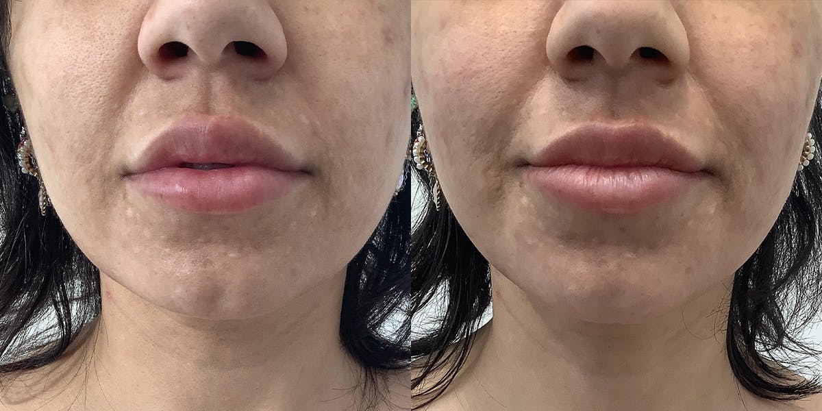 Thread Lift Before & After Gallery - Patient 176796 - Image 1