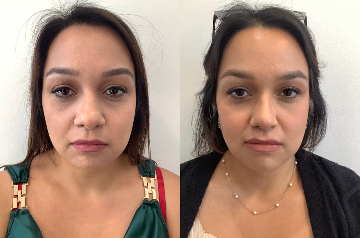Rhinoplasty Before & After Gallery - Patient 530294 - Image 1