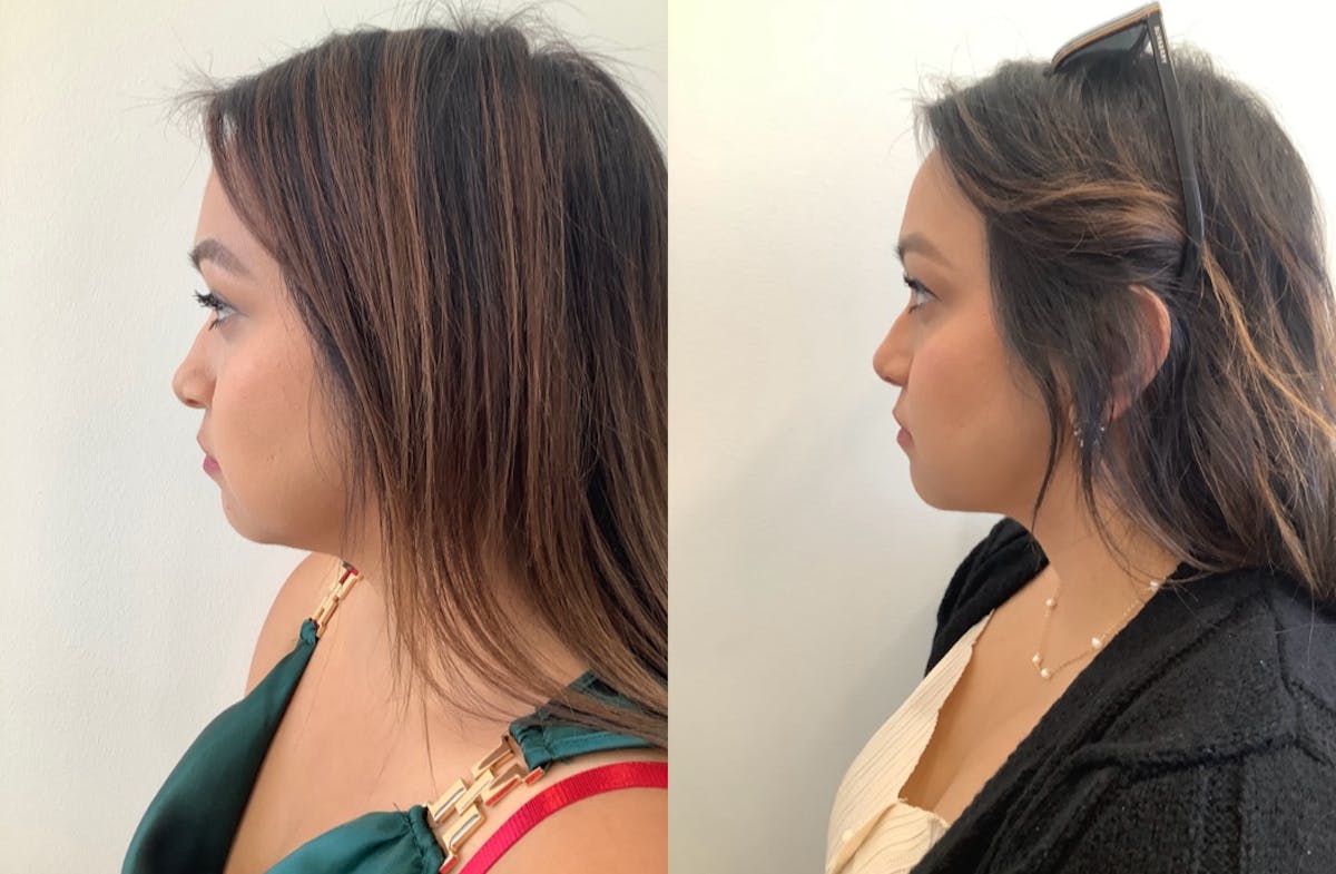 Rhinoplasty Before & After Gallery - Patient 530294 - Image 2