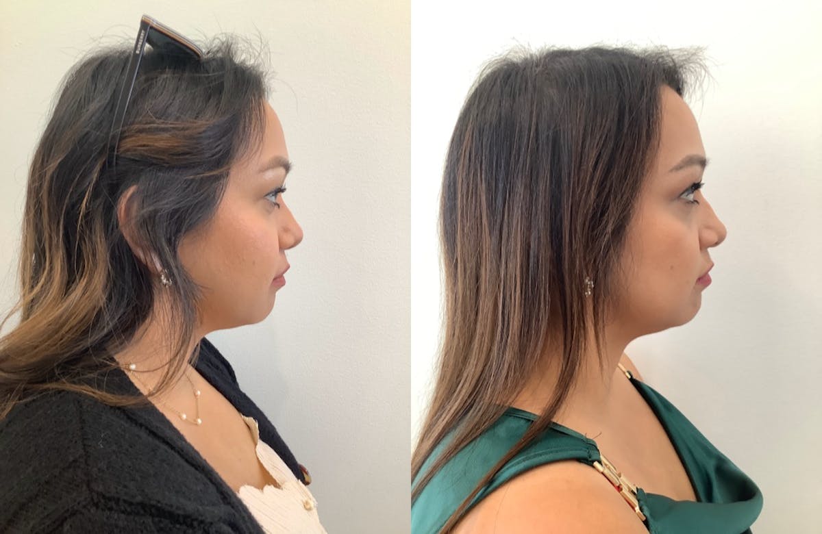 Rhinoplasty Before & After Gallery - Patient 530294 - Image 3