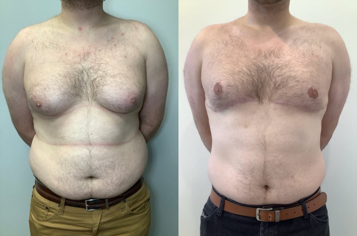 Gynecomastia Before & After Gallery - Patient 580625 - Image 1