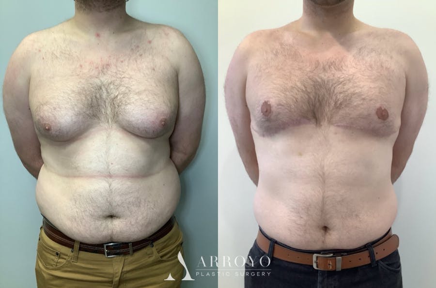 Gynecomastia Before & After Gallery - Patient 580625 - Image 1
