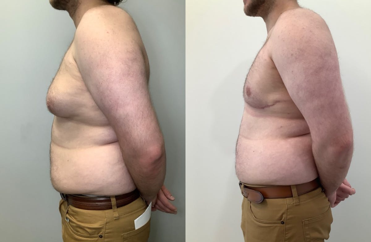 Gynecomastia Before & After Gallery - Patient 580625 - Image 2