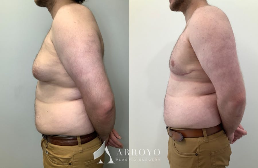 Gynecomastia Before & After Gallery - Patient 580625 - Image 2