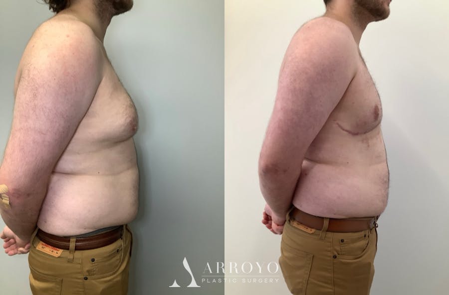 Gynecomastia Before & After Gallery - Patient 580625 - Image 3