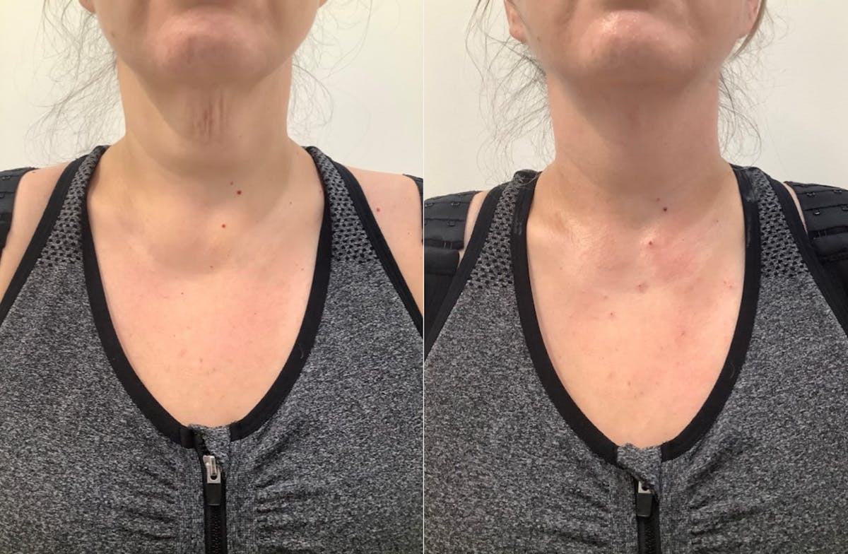 Thread Lift Before & After Gallery - Patient 289568 - Image 1