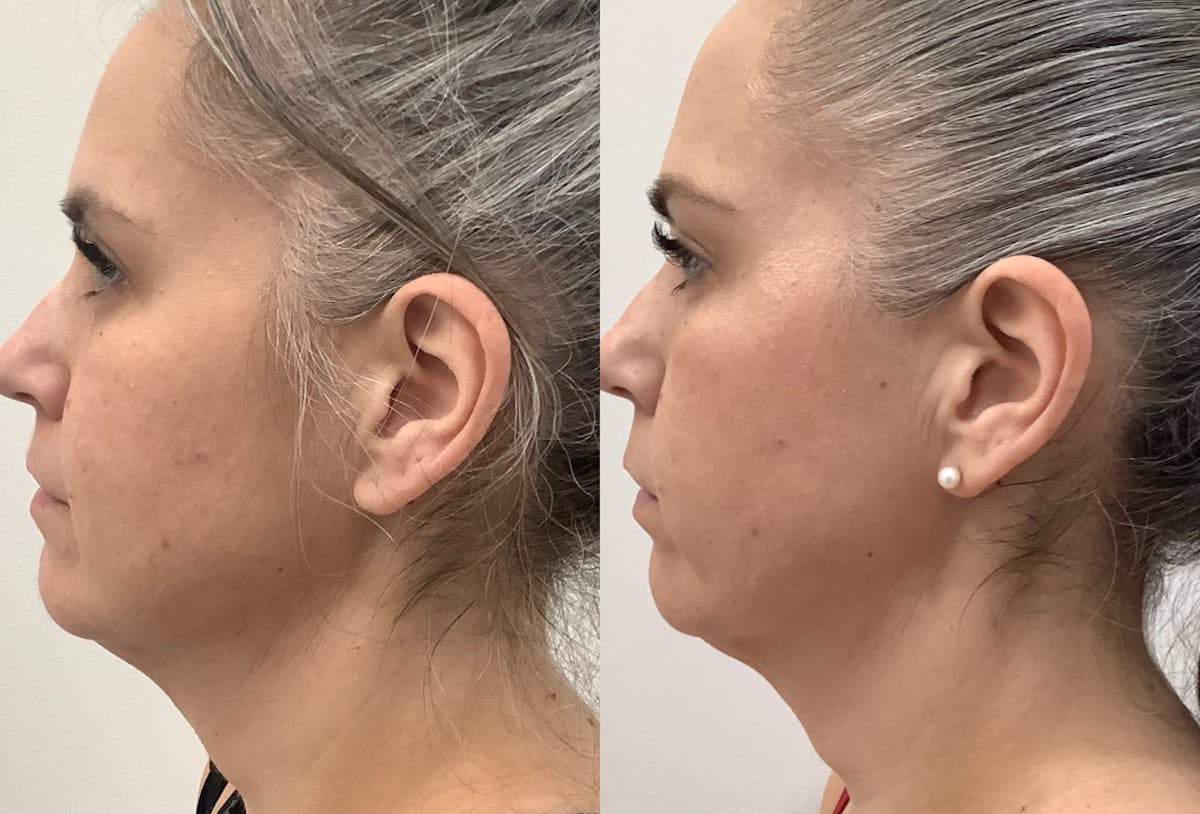 Morpheus8 Before & After Gallery - Patient 219178 - Image 1