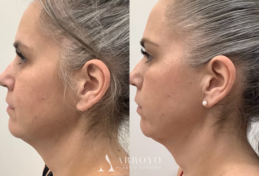 Morpheus8 Before & After Gallery - Patient 219178 - Image 1