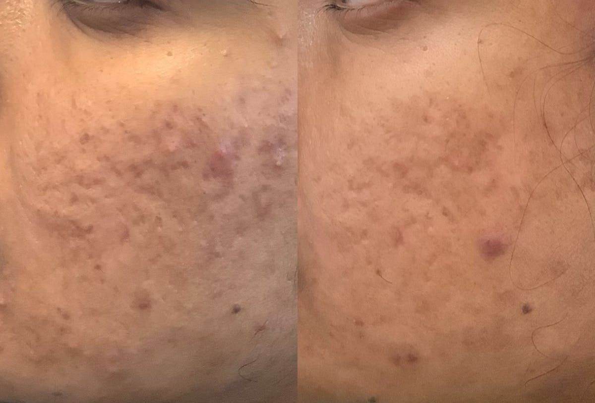 Morpheus8 Before & After Gallery - Patient 290160 - Image 1