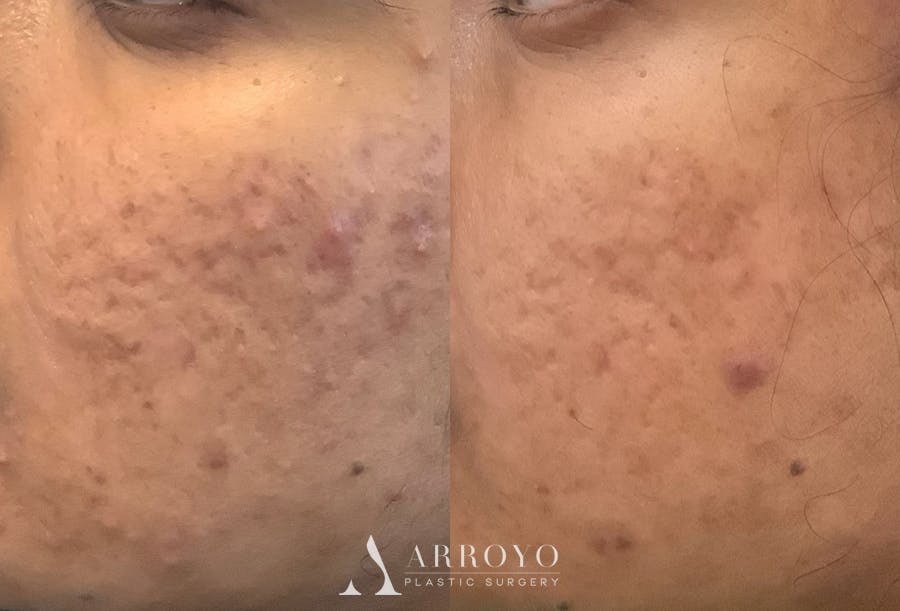 Morpheus8 Before & After Gallery - Patient 290160 - Image 1