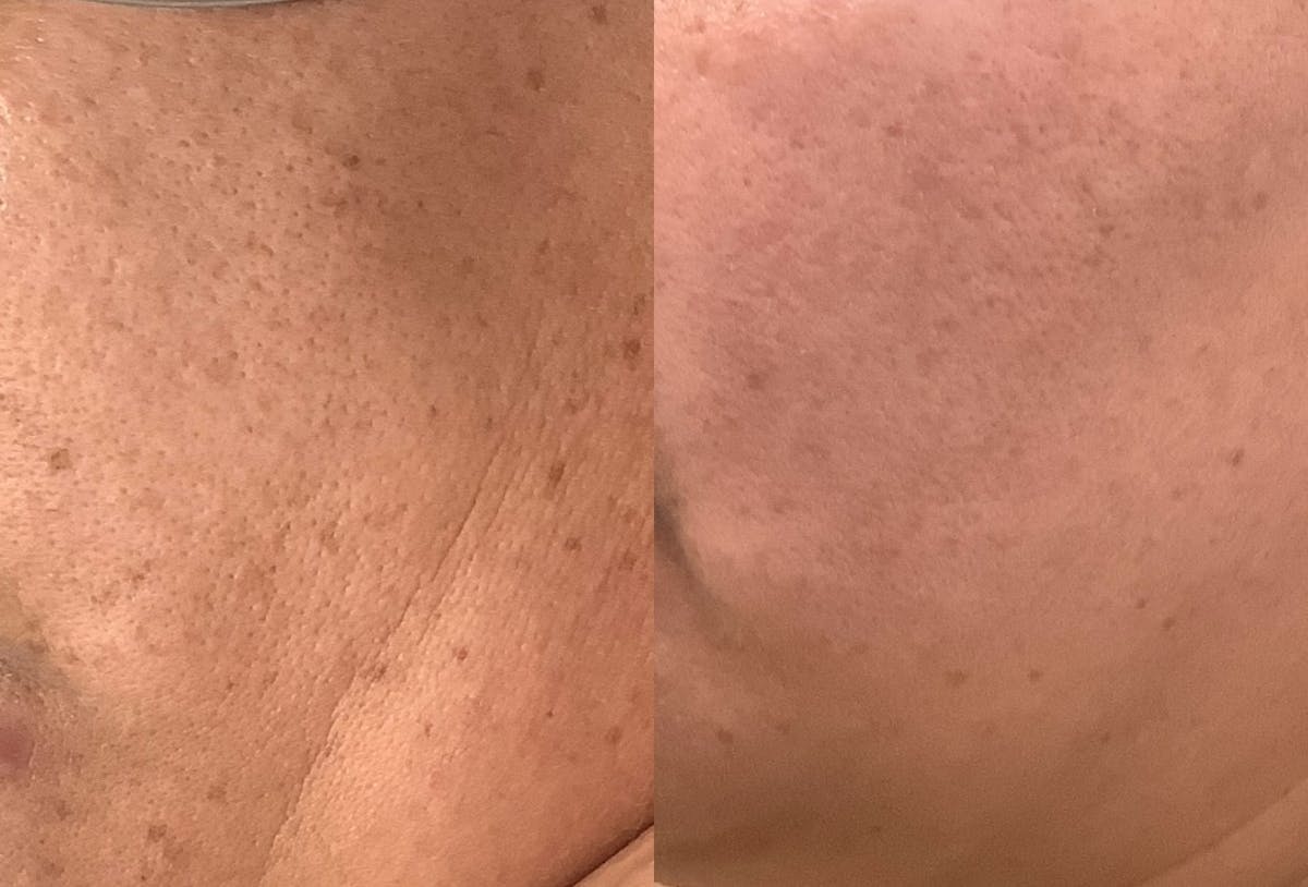 BBL Laser Before & After Gallery - Patient 274890 - Image 1