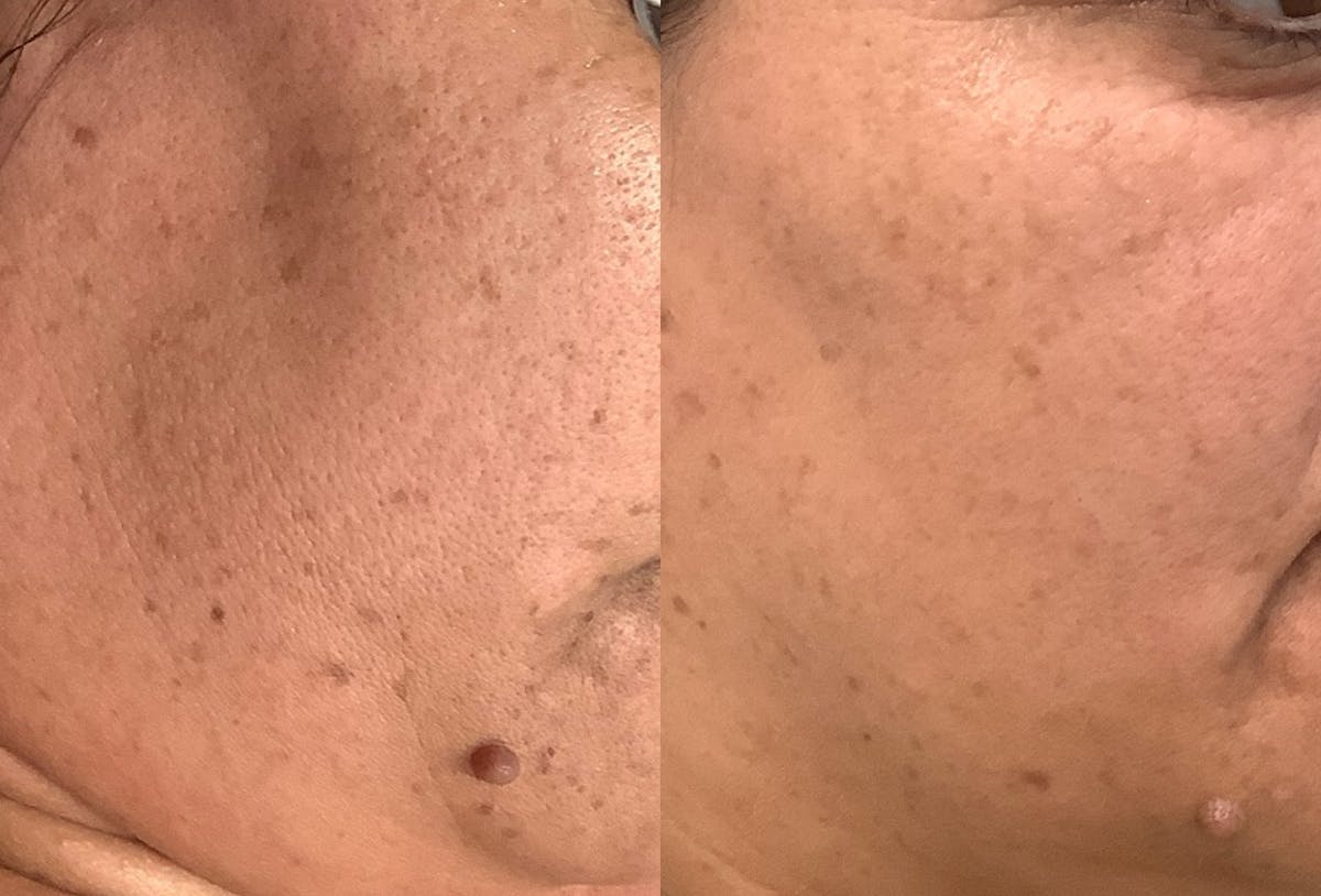 BBL Laser Before & After Gallery - Patient 274890 - Image 2